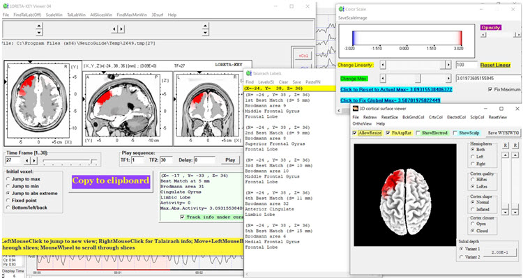 Figure 21 - Post-neurofeedback eyes-closed z-score LORETA analysis for 27 Hz showing little change
